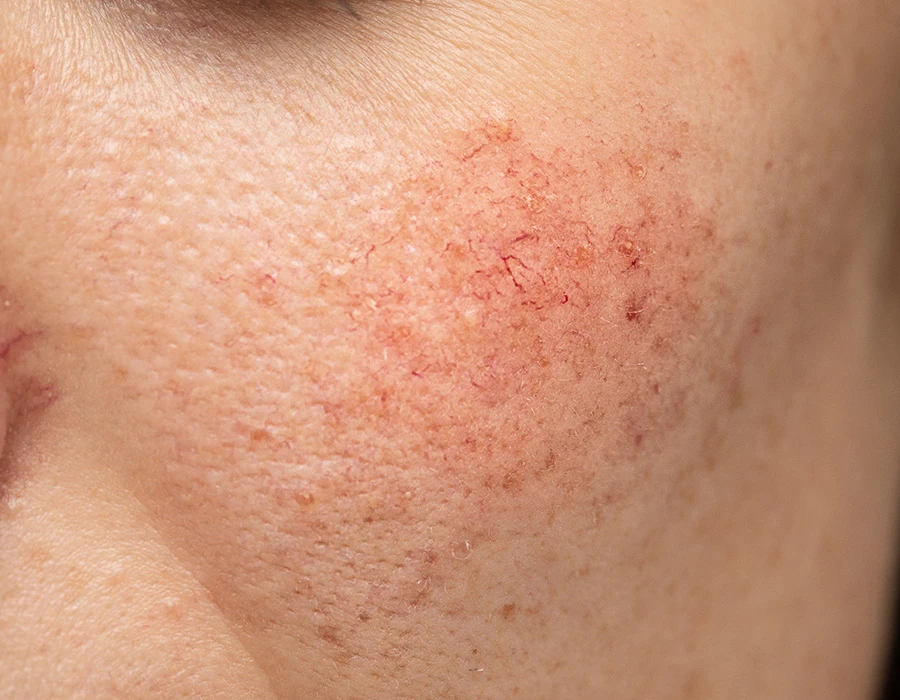 Close-up van huid met roodheid en gesprongen adertjes als uiterlijke symptomen van een alcoholist.